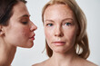 Brunette woman with acne skin looking at the blonde freckled girl while posing