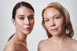 One woman with clear fresh skin and another having acne symptoms