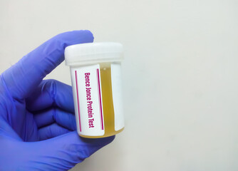 Canvas Print - Urine specimen for Bence Jonce Protein test at medical laboratory. diagnosis for multiple myeloma