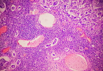 Poster - Low power photomicrograph of a breast core biopsy showing an invasive ductal carcinoma grade-II,  most common form of breast cancer. Lymphovascular invasion: Present