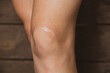 © Виктория Котлярчук - knees of a young white-skinned girl with a scar closeup