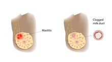 Mastitis and clogged milk duct comparison, illustration