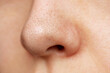 Close-up of a female nose with blackheads or black dots. Acne problem, comedones. Enlarged pores on the face. Cosmetology dermatology concept