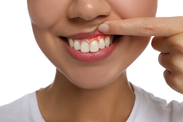 Wall Mural - Young woman showing inflamed gums, closeup view