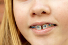 Close Up Of A Teenage Girl Wearing Metal Braces. Orthodontic Dental Braces Teeth Straighteners. Gap Between Front Teeth
