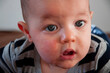 Pięciomiesięczny chłopiec ze skazą białkową. Reakcja alergiczna widoczna na policzkach. Atopowe zapalenie skóry