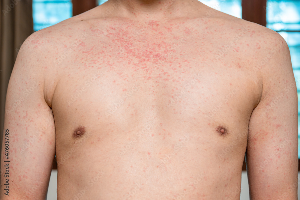 Dermatitis rash viral disease with immunodeficiency on body of young ...