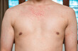 © Mumemories - Dermatitis rash viral disease with immunodeficiency on body of young adult asian, scratch with itch