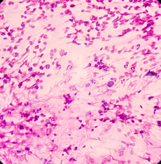 Wall Mural - Pancreatic mass(CT Guided FNA): Positive malignant cell, adenocarcinoma, atypical epithelial cells, pleomorphism with prominent nuclei and cytoplasm, chronic inflammatory cells.