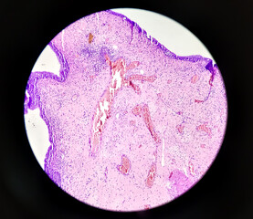 Uterus wall: Simple endometrial hyperplasia, show revealing features of simple endometrial hyperplasia, no malignant cells present.