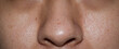© ZAY WIN HTAI - Blackheads or black heads on nose of Asian man.