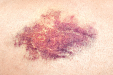 Close-up of a bruise on the wounded skin of a woman's leg. 