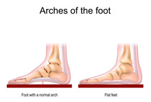 Foot With A Normal Arch And Flat Feet.