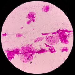 Poster - High Vaginal Swab (HVS): gram stained microscopic view of epithelial cells with gram positive Diplococci bacteria and few gram negative rods shape bacillus, Streptococcus, Staphylococcus