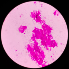 Poster - High Vaginal Swab (HVS): gram stained microscopic view of epithelial cells with gram positive Diplococci bacteria and few gram negative rods shape bacillus, Streptococcus, Staphylococcus