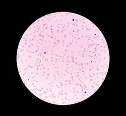 Poster - Photomicrograph of Leuco-erythroblastic anemia. 40X