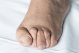 Fototapeta Sypialnia - Bunion on foot of senior man with hammer toes and dry skin over white background. Hygiene, surgery, health care, podiatrist, dermatology concepts