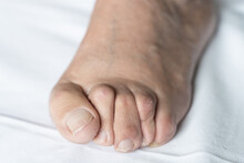 Bunion On Foot Of Senior Man With Hammer Toes And Dry Skin Over White Background. Hygiene, Surgery, Health Care, Podiatrist, Dermatology Concepts