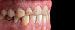 © Garo - press ceramic crowns and veneers natural color