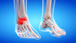 3d rendered medically accurate illustration of a painful ankle joint