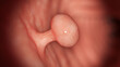 3d rendered illustration of a colon polyp