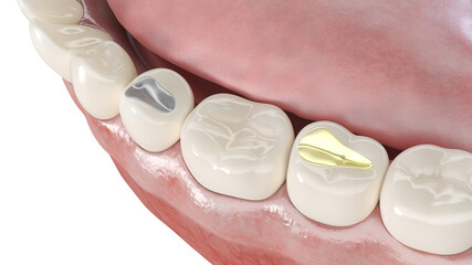 3d rendered illustration of different dental fillings
