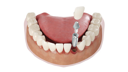 Wall Mural - 3d rendered illustration of a dental implant
