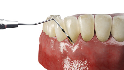 Wall Mural - 3d rendered illustration of periodontitis testing