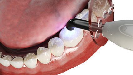 Wall Mural - 3d rendered illustration of a dental polymerization process