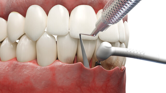 3d rendered illustration of dental pocket reduction