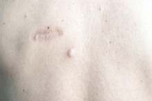 Image Of A Person's Skin With Scars