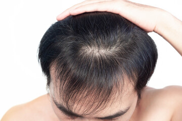 Closeup Young man serious hair loss problem with white backgroun for health care medical and shampoo product concept, selective focus