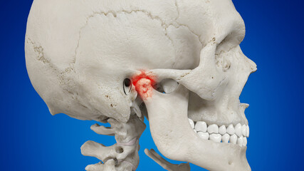 Poster - 3d rendered illustration of an inflamed temporomandibular joint