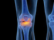 3d rendered illustration of an inflamed knee joint