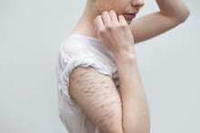 Young Woman With Pale Scars Arm