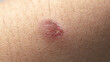 © itsuky - hot oil burns on the skin, causing the skin to turn red and die. Wounds caused by scalding hot water. wound inflammation. Burns that begin to heal and dry on the skin