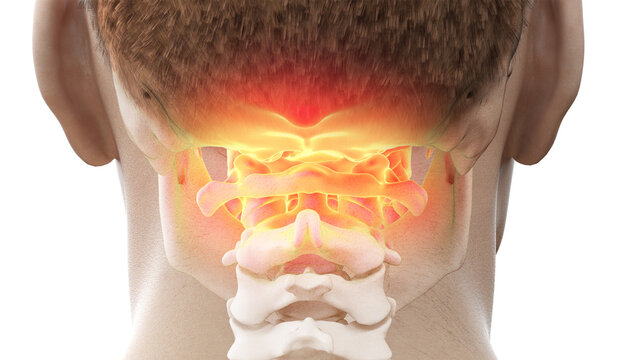3d rendered illustration of a painful atlas bone