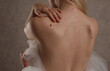 Checking benign moles : Sensual Beautiful Woman with birthmarks on her back. Laser skin tags removal