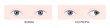 Exotropia. Horizontal strabismus before and after surgery. Eye misalignment, cross-eyed condition. Human eyes healthy and with outward gaze position. Double vision. Vector cartoon illustration