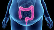 3d rendered illustration of an obese mans colon