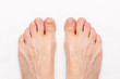 Close-up of a male foot with yellow ugly fungus on toenails and healed nails before and after treatmet isolated on a white background. Fungal nail infection.
Advanced stage of disease. Top view