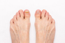 Close-up Of A Male Foot With Yellow Ugly Fungus On Toenails And Healed Nails Before And After Treatmet Isolated On A White Background. Fungal Nail Infection.
Advanced Stage Of Disease. Top View