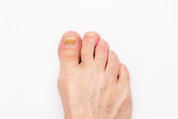 Wall Mural - Close-up of a male foot with yellow ugly fungus on toenails isolated on white background. Fungal nail infection caused by excessive sweating, nail injury,
Advanced stage of disease. Top view