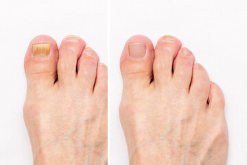 Macro shot of a male foot with yellow ugly fungus on toenails and healthy nails before and after treatmet isolated on a white background. Fungal nail infection. Advanced stage of disease. Top view