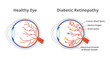 Vector illustration of diabetic retinopathy, a complication of diabetes caused by high blood sugar and normal healthy eye isolated. Cotton wool spots, hemorrhages, aneurysms, abnormal blood vessels.
