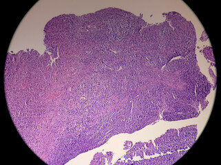 Wall Mural - Microscopic image of Colorectal carcinoma and Amelanotic melanoma. Show malignant neoplasm, atypical squamous epithelial cells and areas of necrosis are noted.