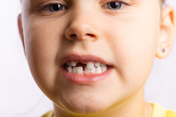 Wall Mural - Close-up of young girl face showing missing front baby tooth looking at camera on white background. First teeth changing going to dentist to do tooth treatment. 