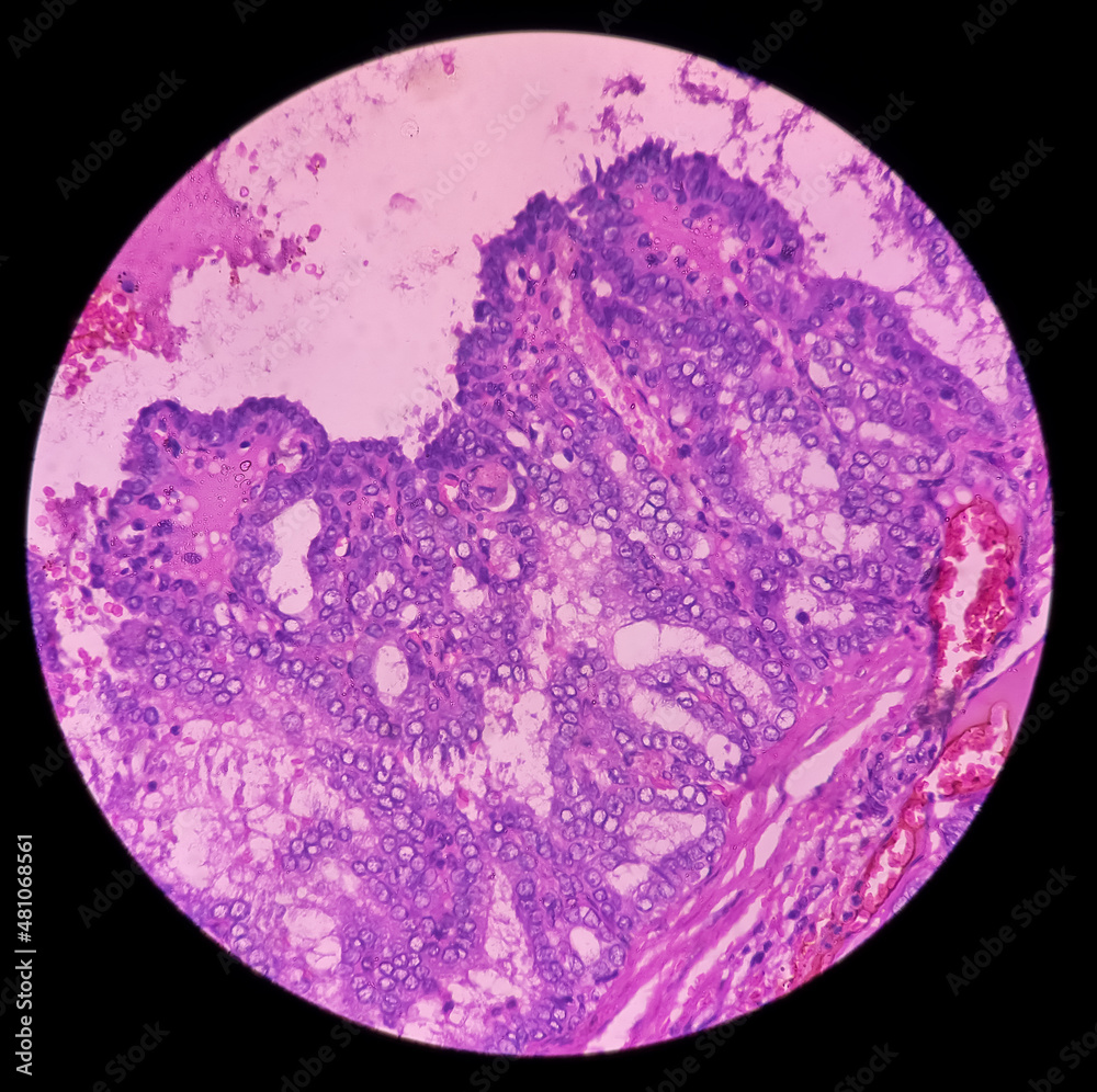 Cervical lymph node cancer: Microscopic image of metastatic papillary ...