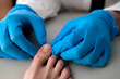 A close-up of a foot with a fungus on the nails is examined by a doctor in gloves. Onycholysis: detachment of the nail from the nail bed.