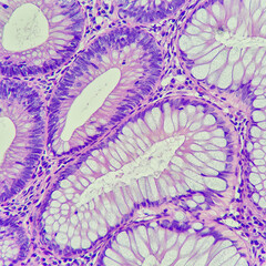 Wall Mural - Camera photo of colonic tubular adenoma, showing dysplastic gland in the left upper and normal gland in the right lower, magnification 400x, photograph through a microscope